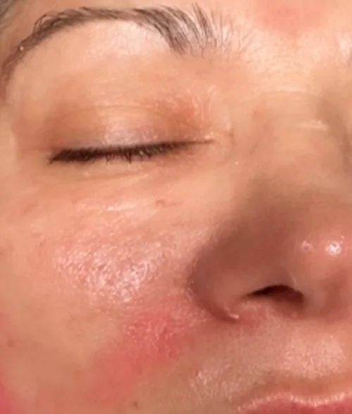 Haut nach dem Microneedling