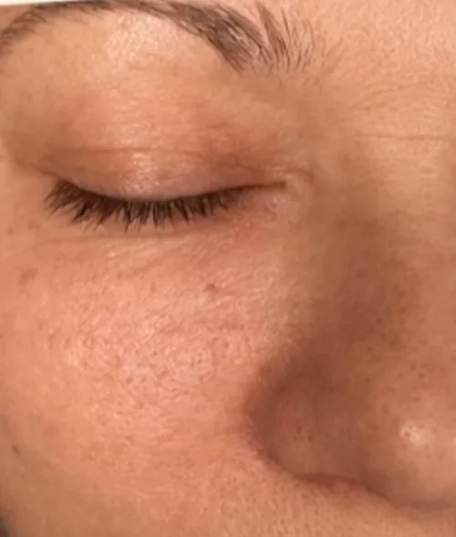Haut vor dem Microneedling