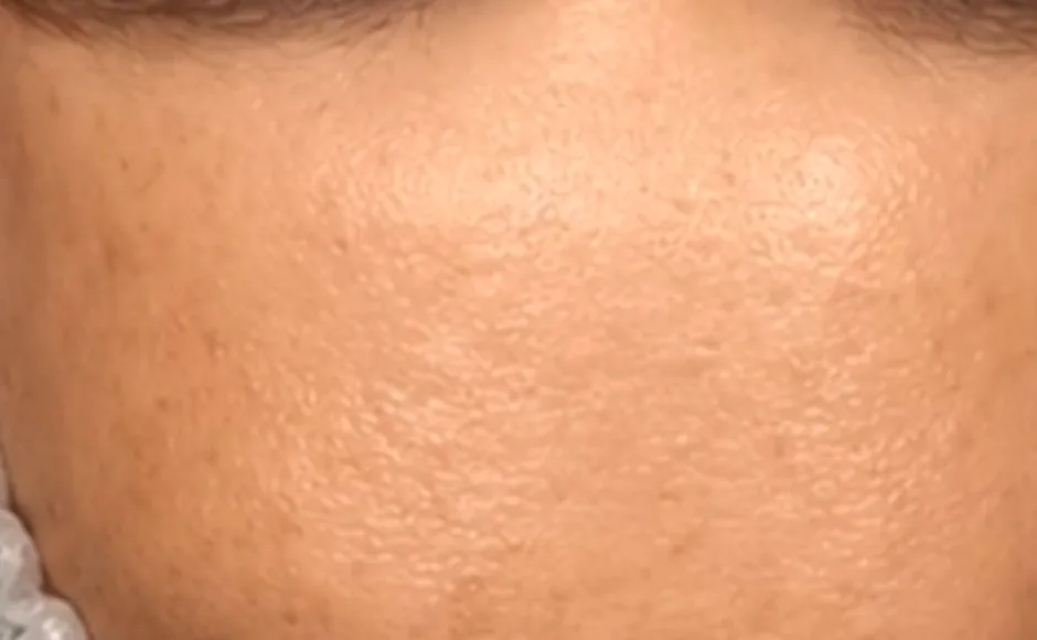 Dieselbe Hautstelle nach der dritten Microneedling Behandlung