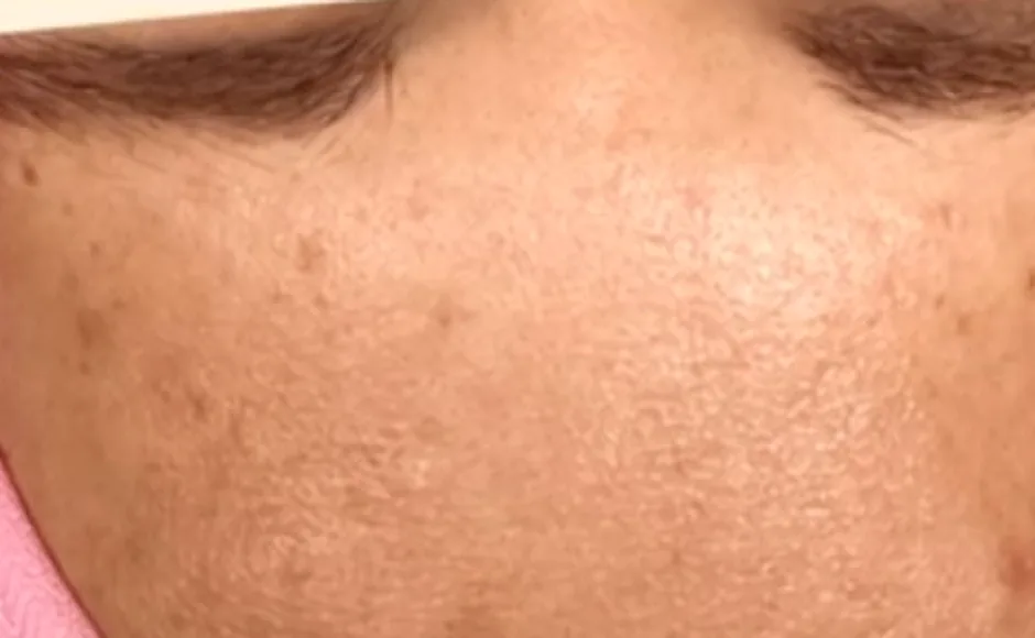 Haut nach der ersten Microneedling Behandlung